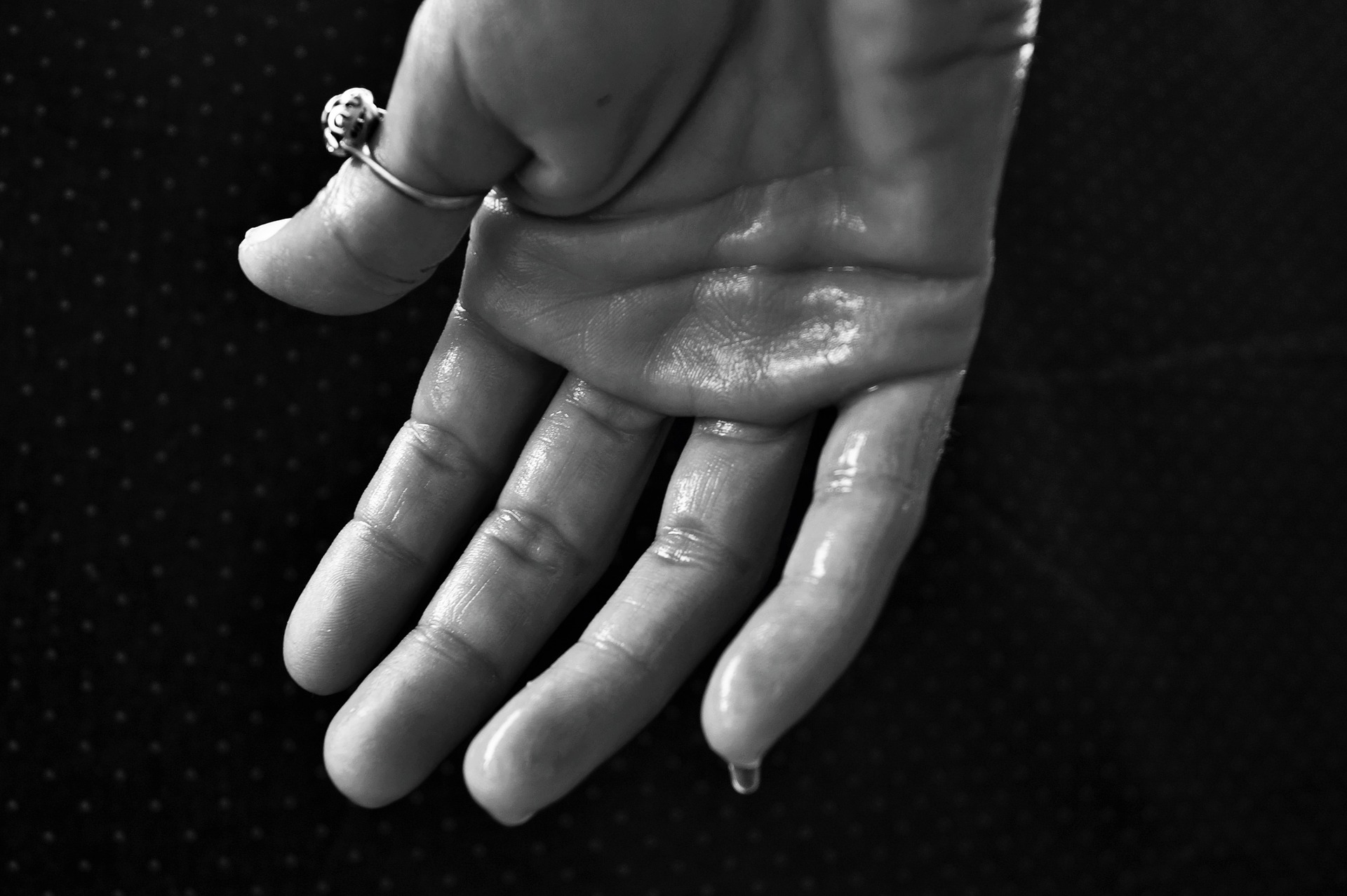 eine verschwitzte, nasse Hand mit einem Ring am Daumen. Bild zum thema: Für immer schweißfrei durch Schweißdrüsenabsaugung Wien?