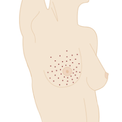 Schönheitsoperation zum Thema Brust: Narbenverlauf und mögliche Bereiche der Brustvergrößerung mit Eigenfett