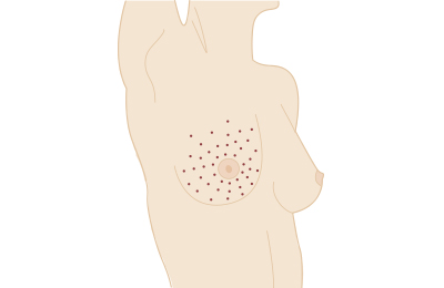 Schönheitsoperation zum Thema Brust: Narbenverlauf und mögliche Bereiche der Brustvergrößerung durch Eigenfett