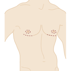 Schönheitsoperation zum Thema Brust: Narbenverlauf und mögliche Bereiche der Gynäkomastie