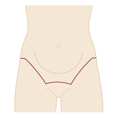 Grid Körper: Oberschenkel und Gesäß - Narbenverlauf und mögliche Bereiche der Fettabsaugung